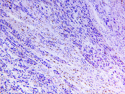 Melanoma of a human, photomicrograph panorama as seen under the microscope, 200x zoom.