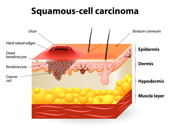 Squamous-cell carcinoma or squamous cell cancer.