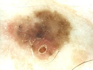 Melanoma on 120x magnification